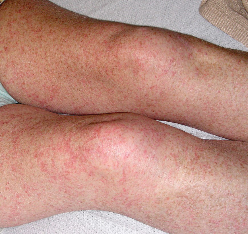 petechial-rash-on-the-thighs-in-an-immunosuppressed-patient-mdedge